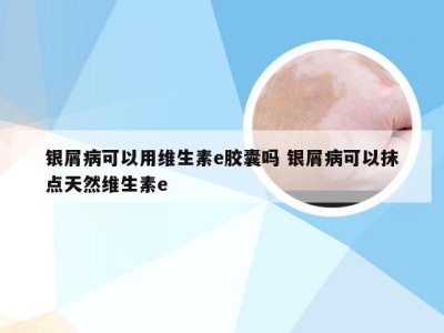 银屑病可以用维生素e胶囊吗 银屑病可以抹点天然维生素e