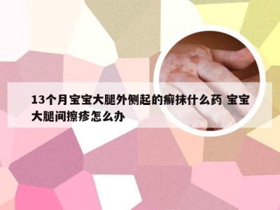 13个月宝宝大腿外侧起的癣抹什么药 宝宝大腿间擦疹怎么办