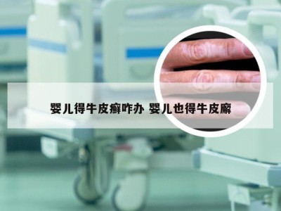 婴儿得牛皮癣咋办 婴儿也得牛皮廨