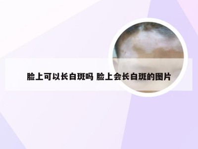 脸上可以长白斑吗 脸上会长白斑的图片