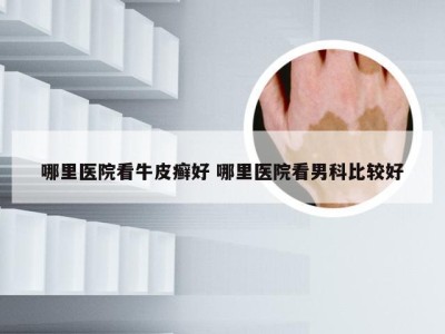 哪里医院看牛皮癣好 哪里医院看男科比较好