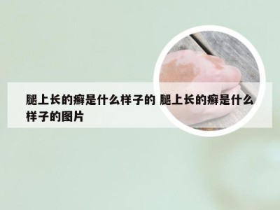 腿上长的癣是什么样子的 腿上长的癣是什么样子的图片