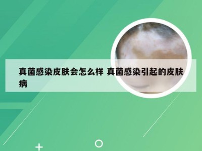 真菌感染皮肤会怎么样 真菌感染引起的皮肤病