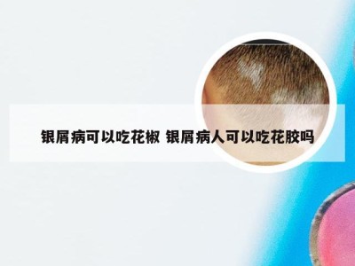 银屑病可以吃花椒 银屑病人可以吃花胶吗