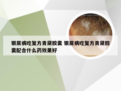 银屑病吃复方青黛胶囊 银屑病吃复方青黛胶囊配合什么药效果好