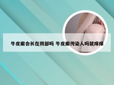 牛皮廨会长在阴部吗 牛皮廨传染人吗就痒痒