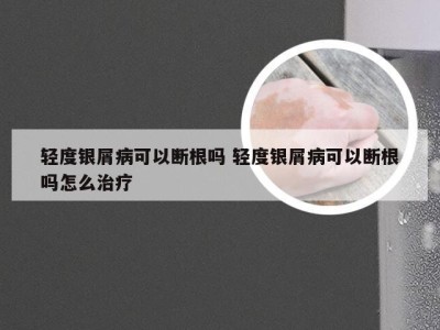 轻度银屑病可以断根吗 轻度银屑病可以断根吗怎么治疗