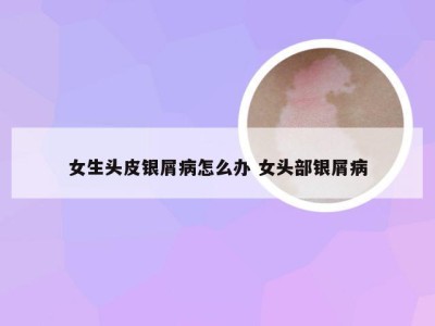 女生头皮银屑病怎么办 女头部银屑病