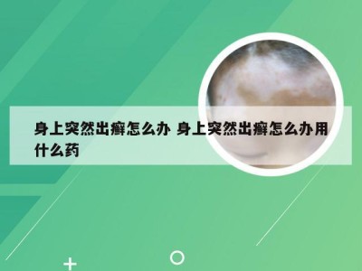 身上突然出癣怎么办 身上突然出癣怎么办用什么药