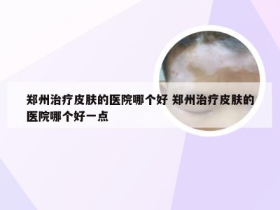 郑州治疗皮肤的医院哪个好 郑州治疗皮肤的医院哪个好一点