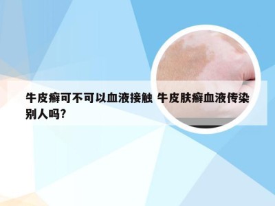 牛皮癣可不可以血液接触 牛皮肤癣血液传染别人吗?