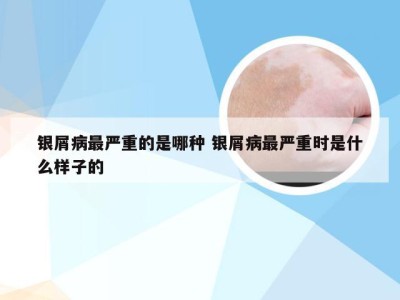 银屑病最严重的是哪种 银屑病最严重时是什么样子的