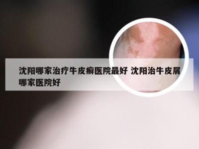 沈阳哪家治疗牛皮癣医院最好 沈阳治牛皮屑哪家医院好