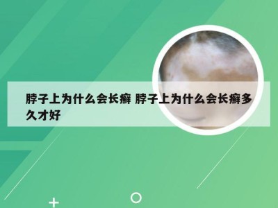 脖子上为什么会长癣 脖子上为什么会长癣多久才好