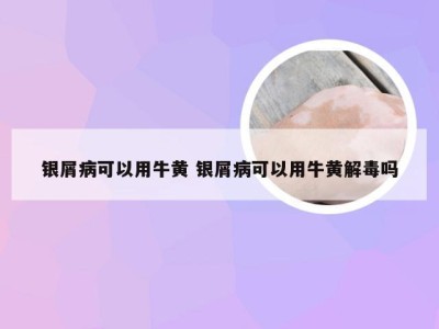 银屑病可以用牛黄 银屑病可以用牛黄解毒吗