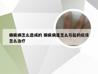 癫疯病怎么造成的 癫疯病是怎么引起的应该怎么治疗