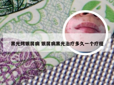 黑光烤银屑病 银屑病黑光治疗多久一个疗程