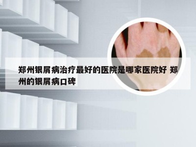 郑州银屑病治疗最好的医院是哪家医院好 郑州的银屑病口碑