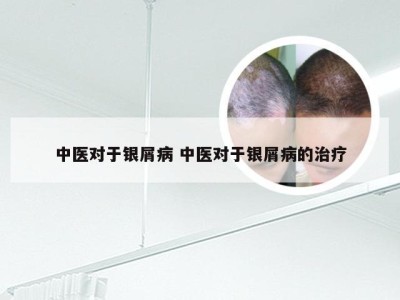 中医对于银屑病 中医对于银屑病的治疗