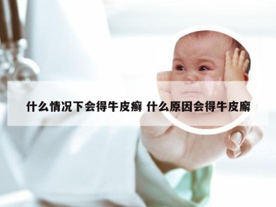 什么情况下会得牛皮癣 什么原因会得牛皮廨