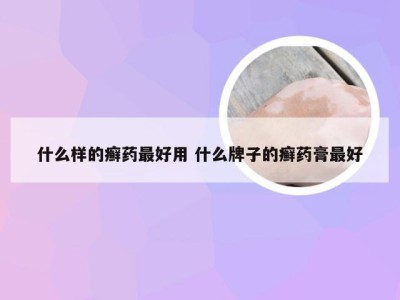 什么样的癣药最好用 什么牌子的癣药膏最好