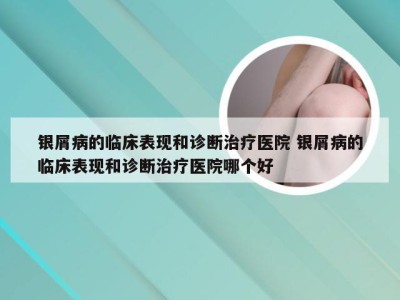 银屑病的临床表现和诊断治疗医院 银屑病的临床表现和诊断治疗医院哪个好