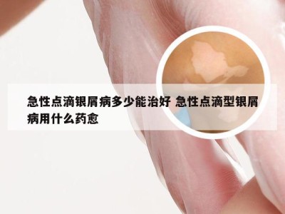 急性点滴银屑病多少能治好 急性点滴型银屑病用什么药愈