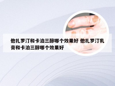 他扎罗汀和卡泊三醇哪个效果好 他扎罗汀乳膏和卡泊三醇哪个效果好