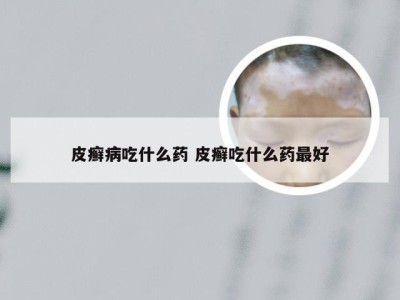 皮癣病吃什么药 皮癣吃什么药最好