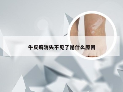 牛皮癣消失不见了是什么原因