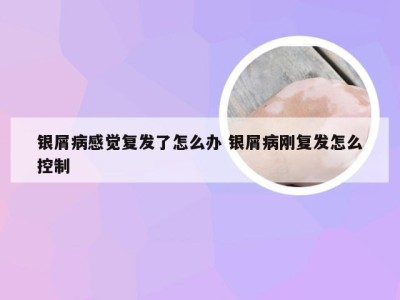 银屑病感觉复发了怎么办 银屑病刚复发怎么控制