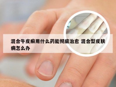 混合牛皮癣用什么药能彻底治愈 混合型皮肤病怎么办