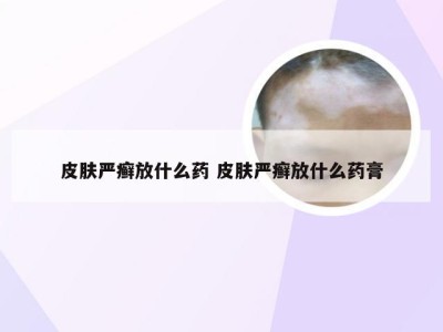 皮肤严癣放什么药 皮肤严癣放什么药膏