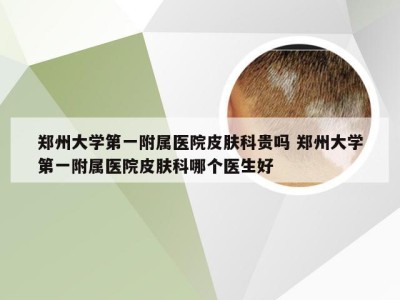 郑州大学第一附属医院皮肤科贵吗 郑州大学第一附属医院皮肤科哪个医生好