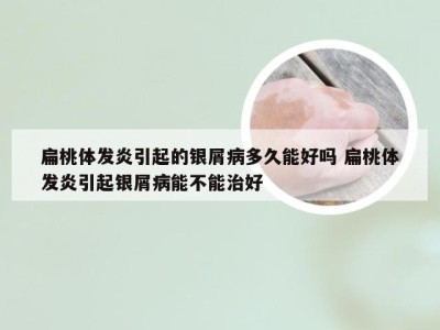 扁桃体发炎引起的银屑病多久能好吗 扁桃体发炎引起银屑病能不能治好