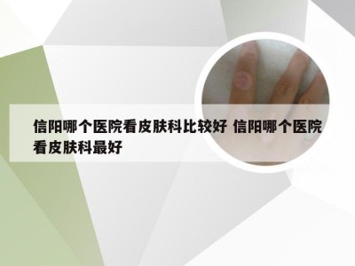 信阳哪个医院看皮肤科比较好 信阳哪个医院看皮肤科最好