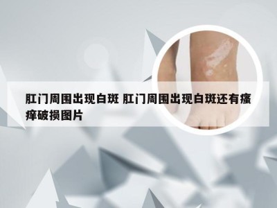 肛门周围出现白斑 肛门周围出现白斑还有瘙痒破损图片