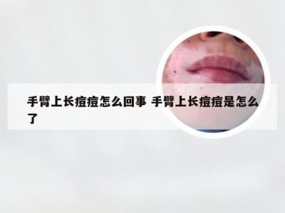 手臂上长痘痘怎么回事 手臂上长痘痘是怎么了