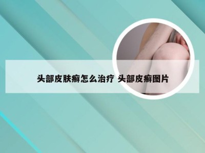 头部皮肤癣怎么治疗 头部皮癣图片