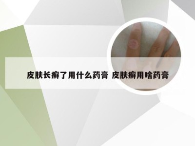 皮肤长癣了用什么药膏 皮肤癣用啥药膏