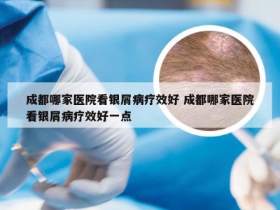 成都哪家医院看银屑病疗效好 成都哪家医院看银屑病疗效好一点