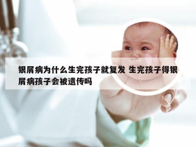 银屑病为什么生完孩子就复发 生完孩子得银屑病孩子会被遗传吗