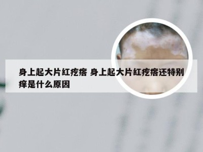 身上起大片红疙瘩 身上起大片红疙瘩还特别痒是什么原因