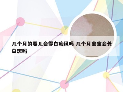 几个月的婴儿会得白癜风吗 几个月宝宝会长白斑吗