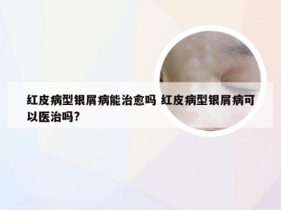 红皮病型银屑病能治愈吗 红皮病型银屑病可以医治吗?