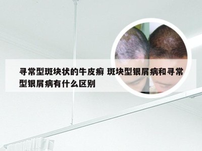 寻常型斑块状的牛皮癣 斑块型银屑病和寻常型银屑病有什么区别