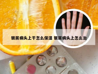 银屑病头上干怎么保湿 银屑病头上怎么治