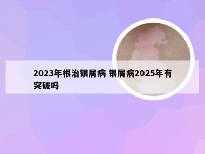 2023年根治银屑病 银屑病2025年有突破吗