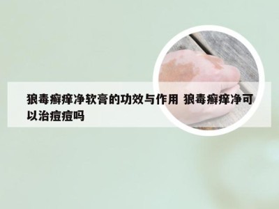 狼毒癣痒净软膏的功效与作用 狼毒癣痒净可以治痘痘吗