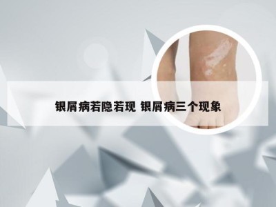 银屑病若隐若现 银屑病三个现象